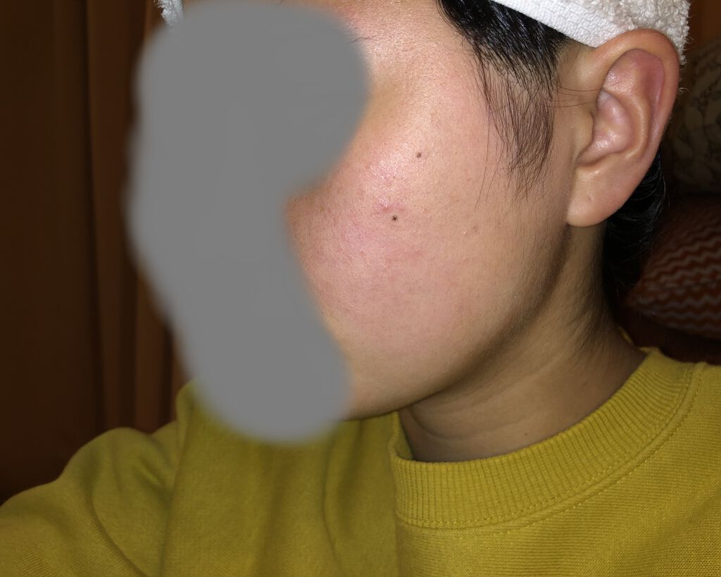 オードムーゲ 薬用ローション（ふきとり化粧水）/オードムーゲ/拭き取り化粧水を使ったクチコミ（2枚目）