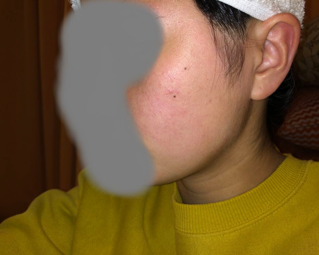 オードムーゲ 薬用ローション(ふきとり化粧水)/オードムーゲ/拭き取り化粧水を使ったクチコミ(2枚目)