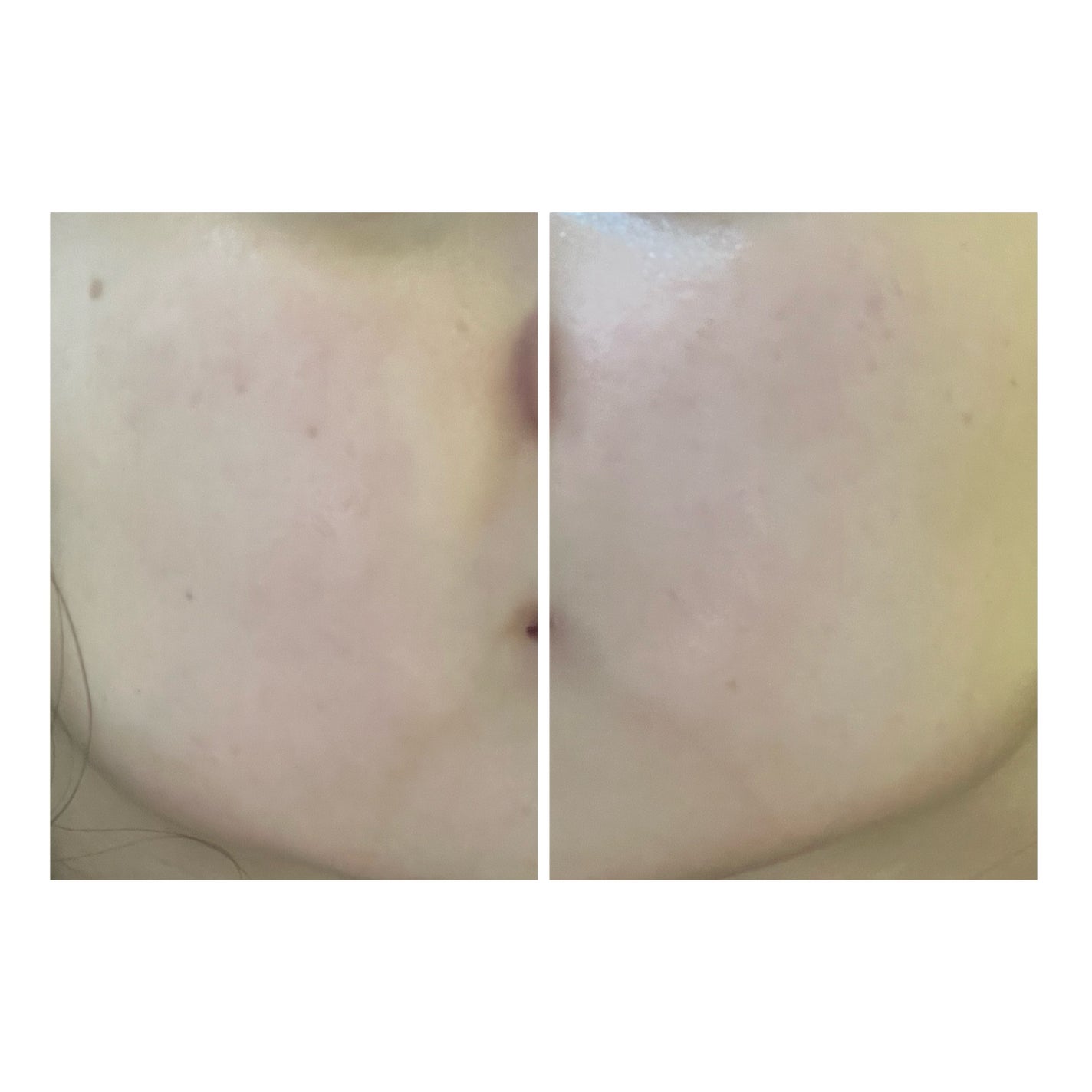 ぽむ on LIPS 「2023.9.13皮膚科に受診 エピデュオとヘパリン処方1枚目..」(3枚目)