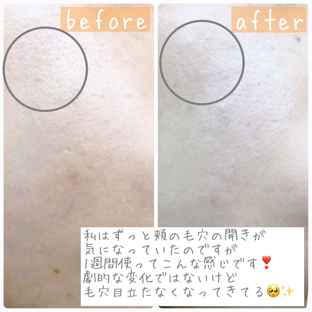 モイスチャーピーリングプロ/Le ment/美顔器・マッサージを使ったクチコミ(5枚目)