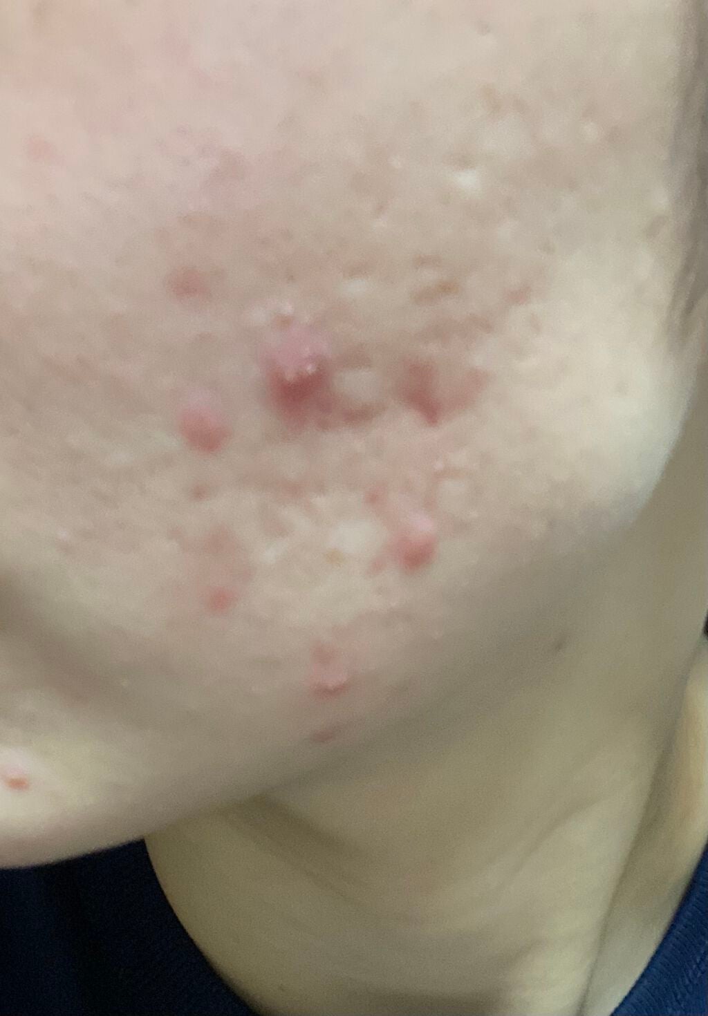 アクネケア セット N/d プログラム/トライアルキットを使ったクチコミ(2枚目)