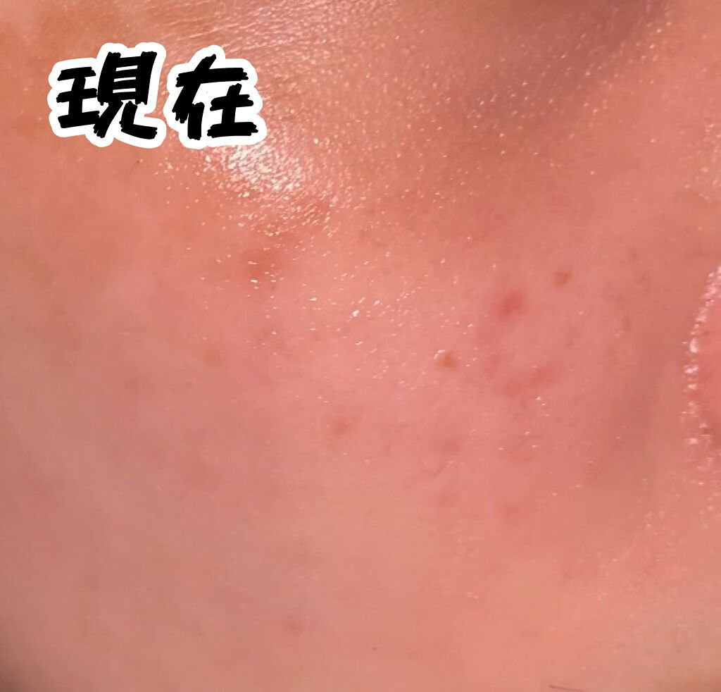 DHC ビタミンＣハードカプセル/DHC/美容サプリメントを使ったクチコミ（3枚目）