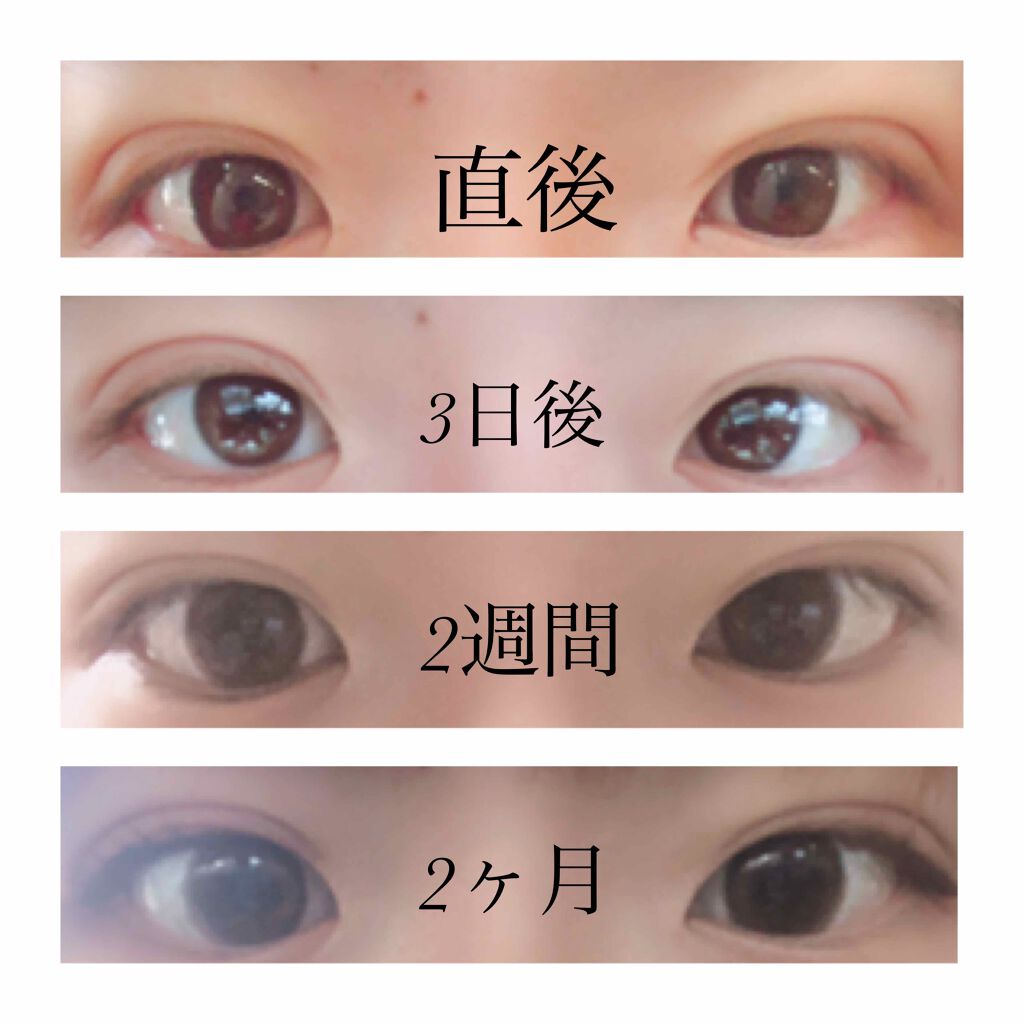 二重整形/その他を使ったクチコミ（3枚目）