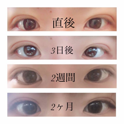 二重整形/その他を使ったクチコミ(3枚目)