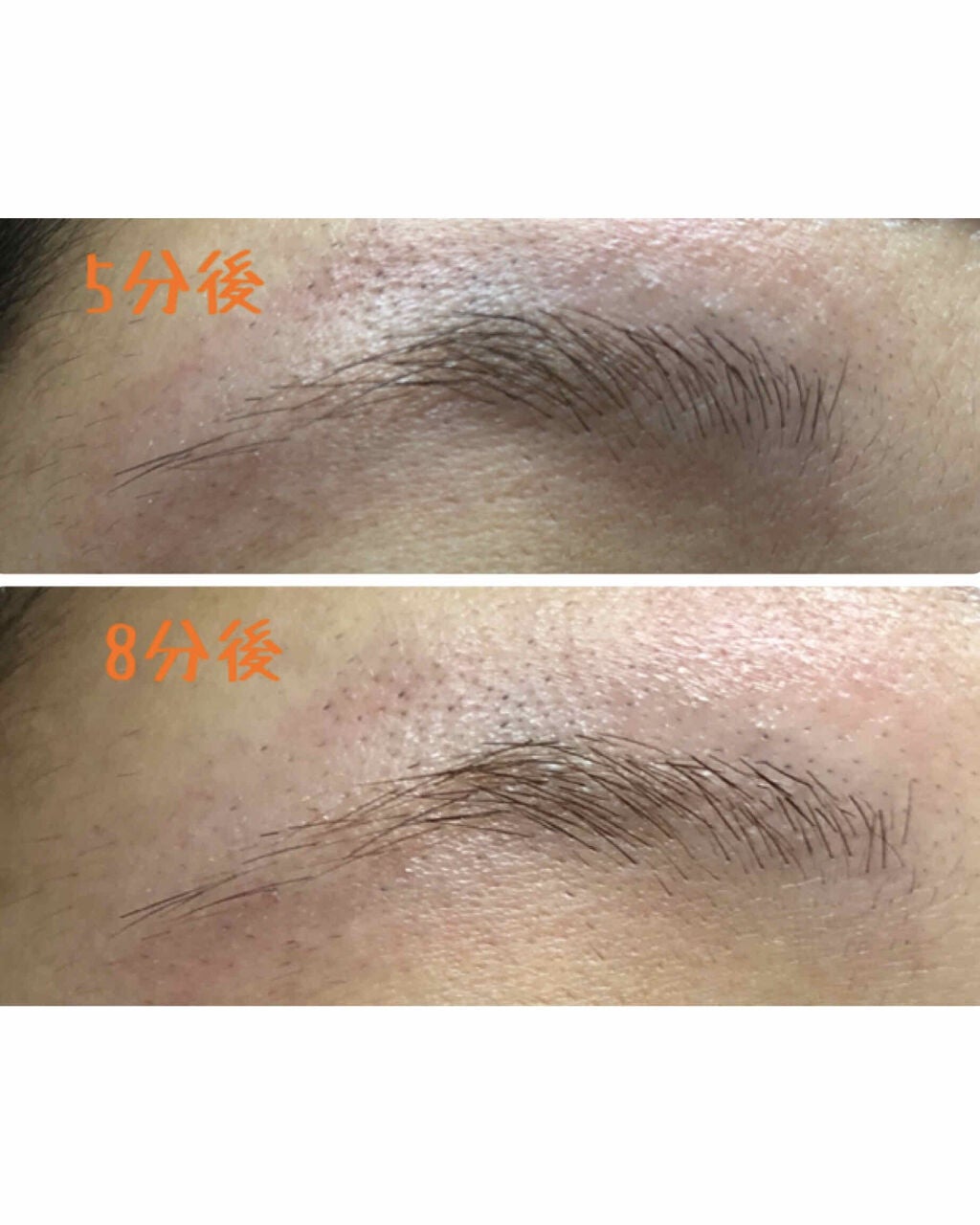 脱色クリーム スピーディー/エピラット/ムダ毛ケアを使ったクチコミ(5枚目)