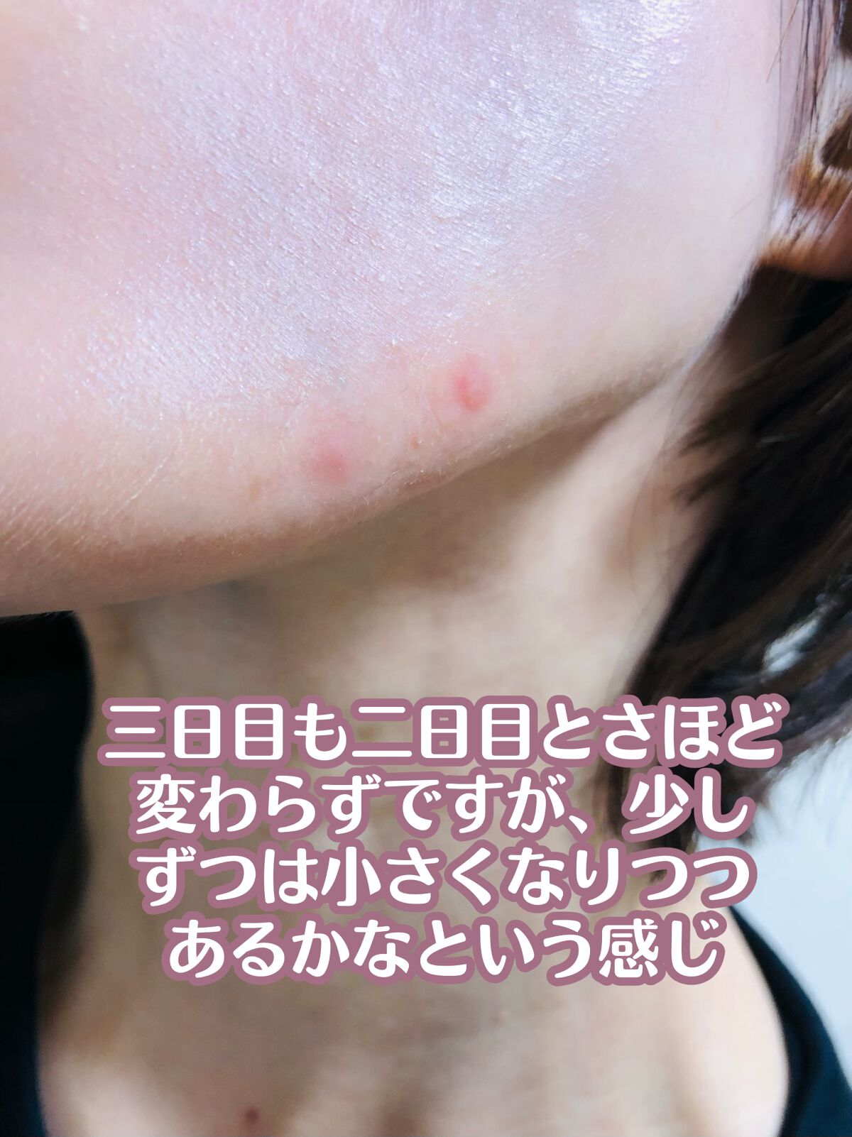 プロCICA クリアスポットパッチ/VT/その他スキンケアを使ったクチコミ（2枚目）