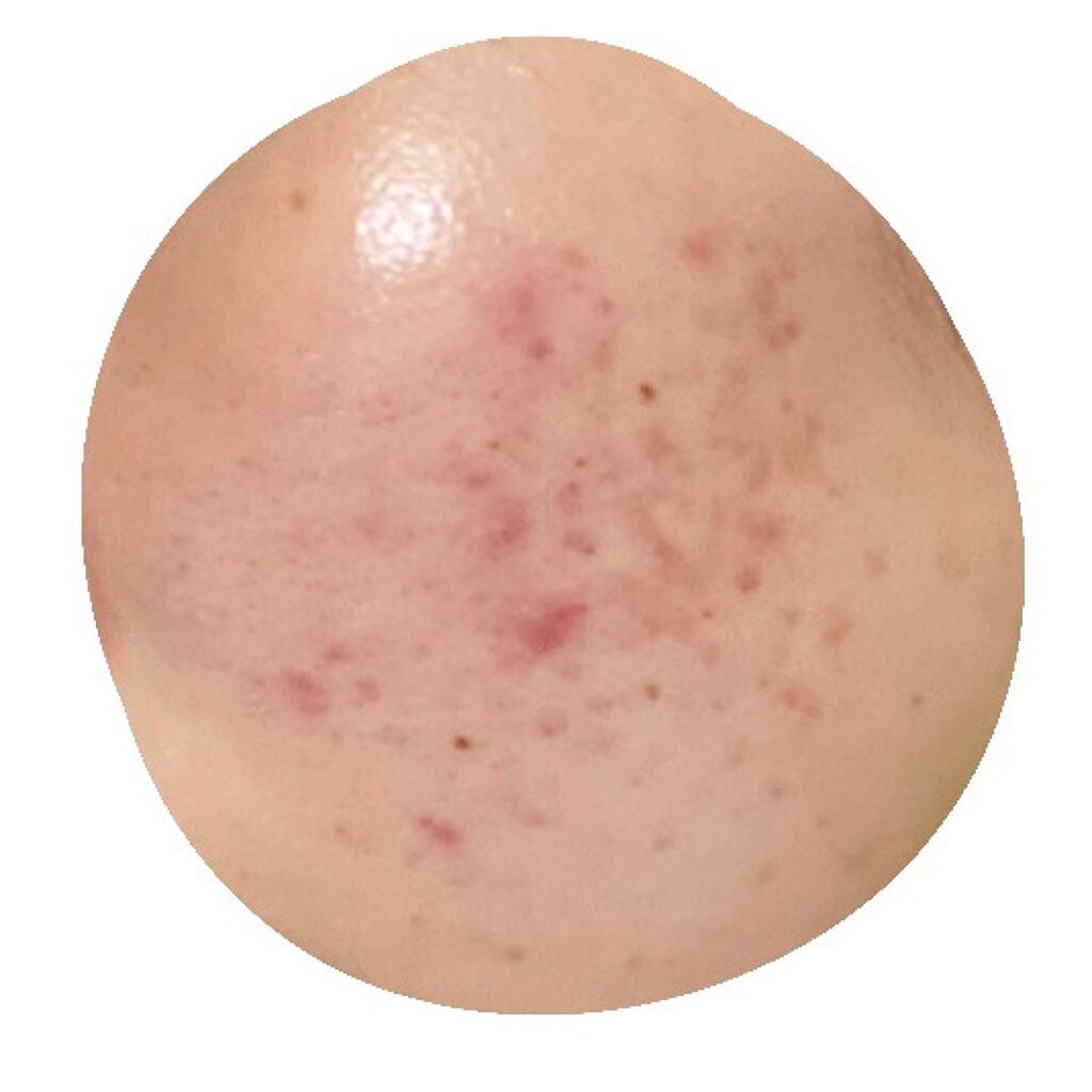 pink_sounds_dlm on LIPS 「前の投稿と比べたらだいぶニキビ跡薄くなったけど、ここからなにを..」(2枚目)