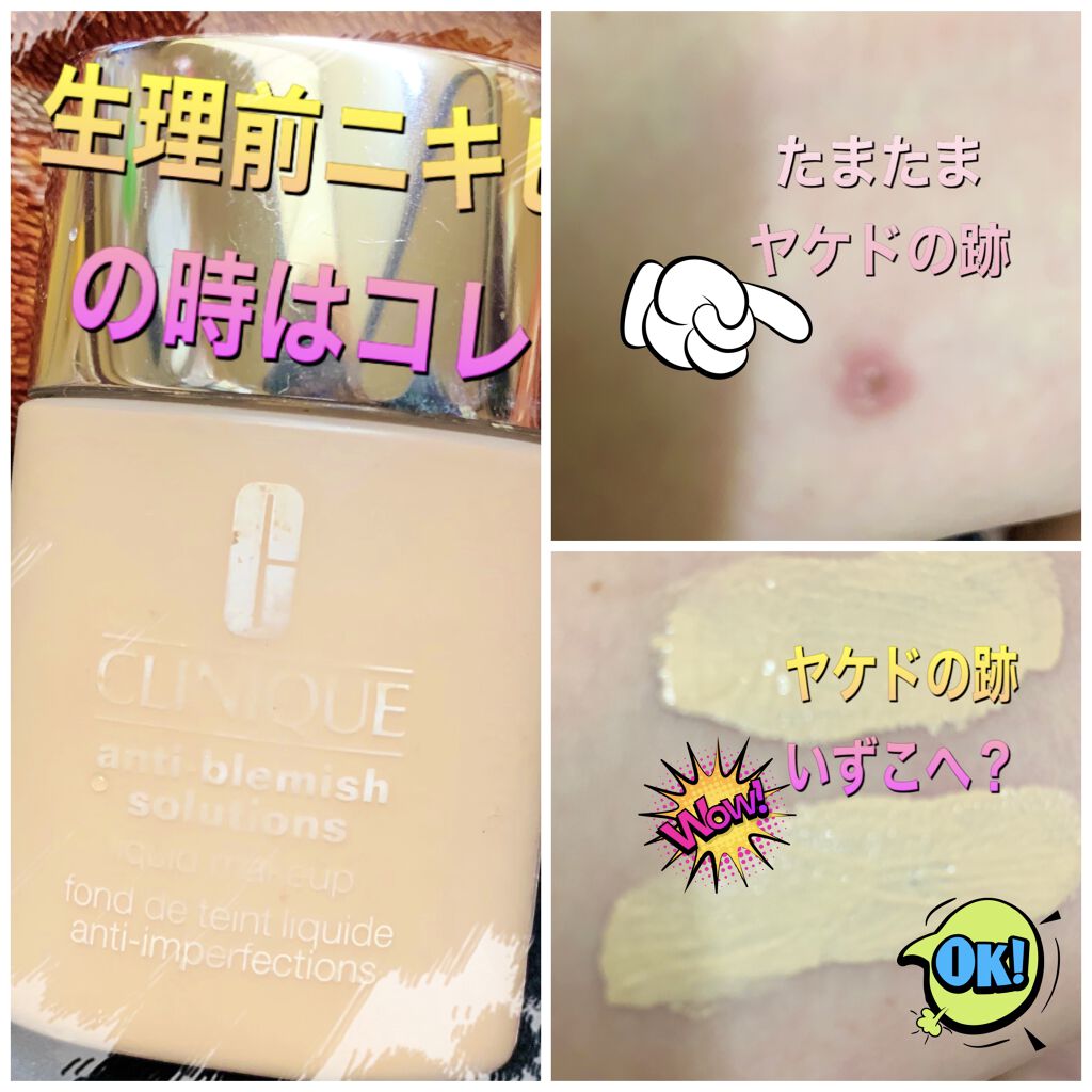 アクネカバーアップリキッドフレッシュ/CLINIQUE/リキッドファンデーションを使ったクチコミ（1枚目）