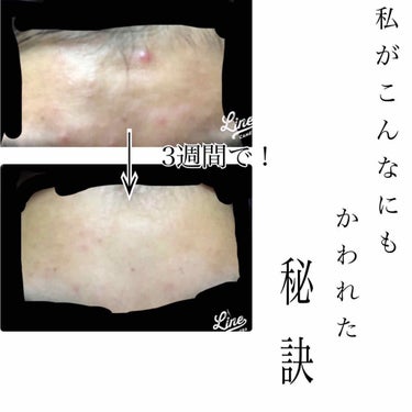 ハトムギ化粧水(ナチュリエ スキンコンディショナー R )/ナチュリエ/化粧水を使ったクチコミ（1枚目）