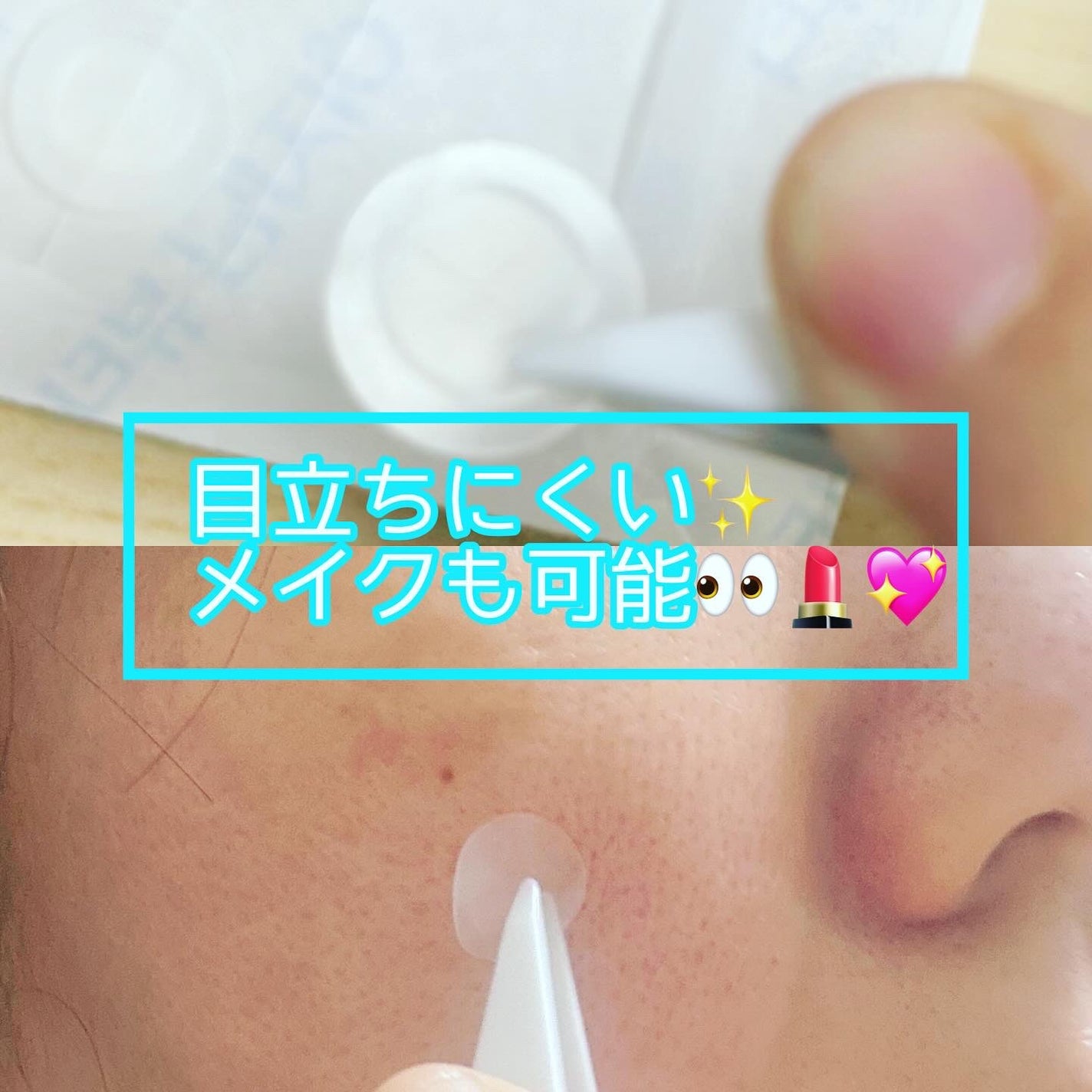 ビューティー スポットパッチ/イージーダムビューティー/にきびパッチを使ったクチコミ(3枚目)