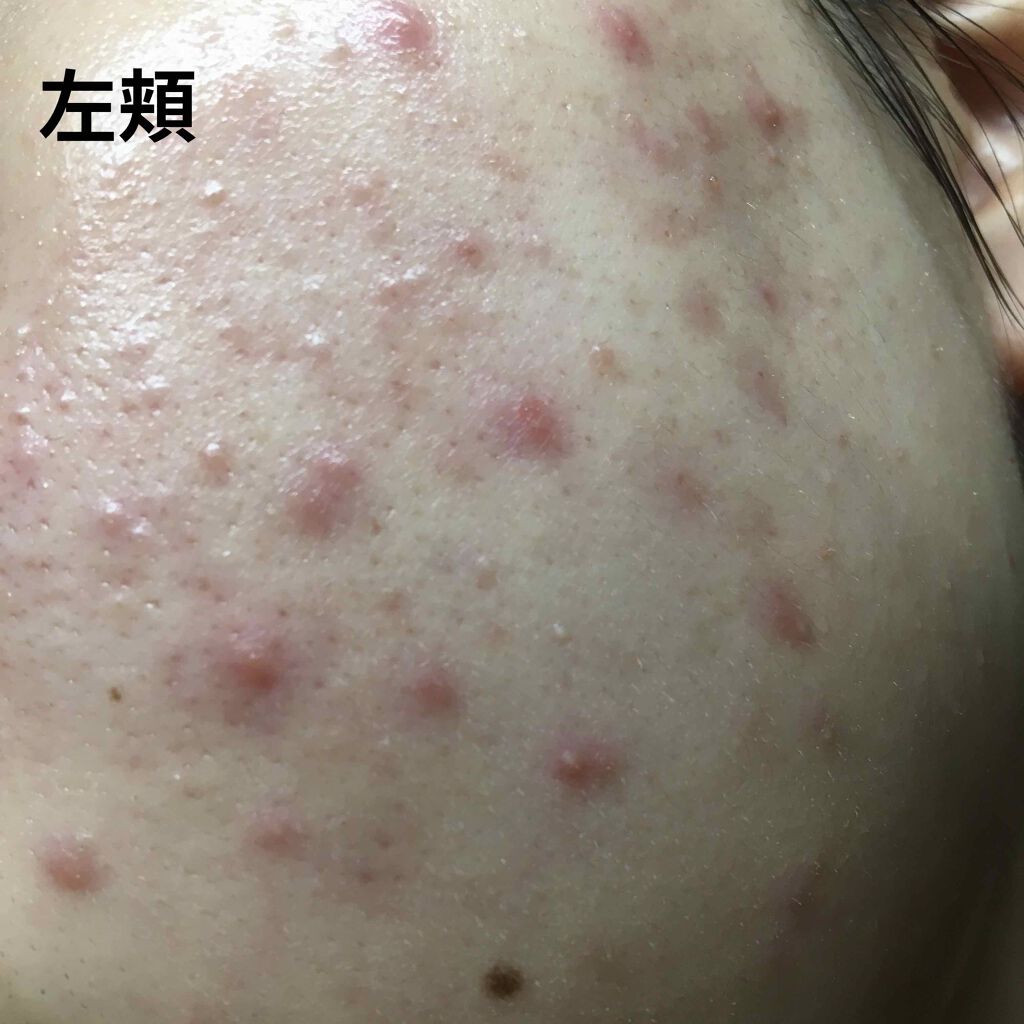 ハトムギ化粧水(ナチュリエ スキンコンディショナー R )/ナチュリエ/化粧水を使ったクチコミ(2枚目)