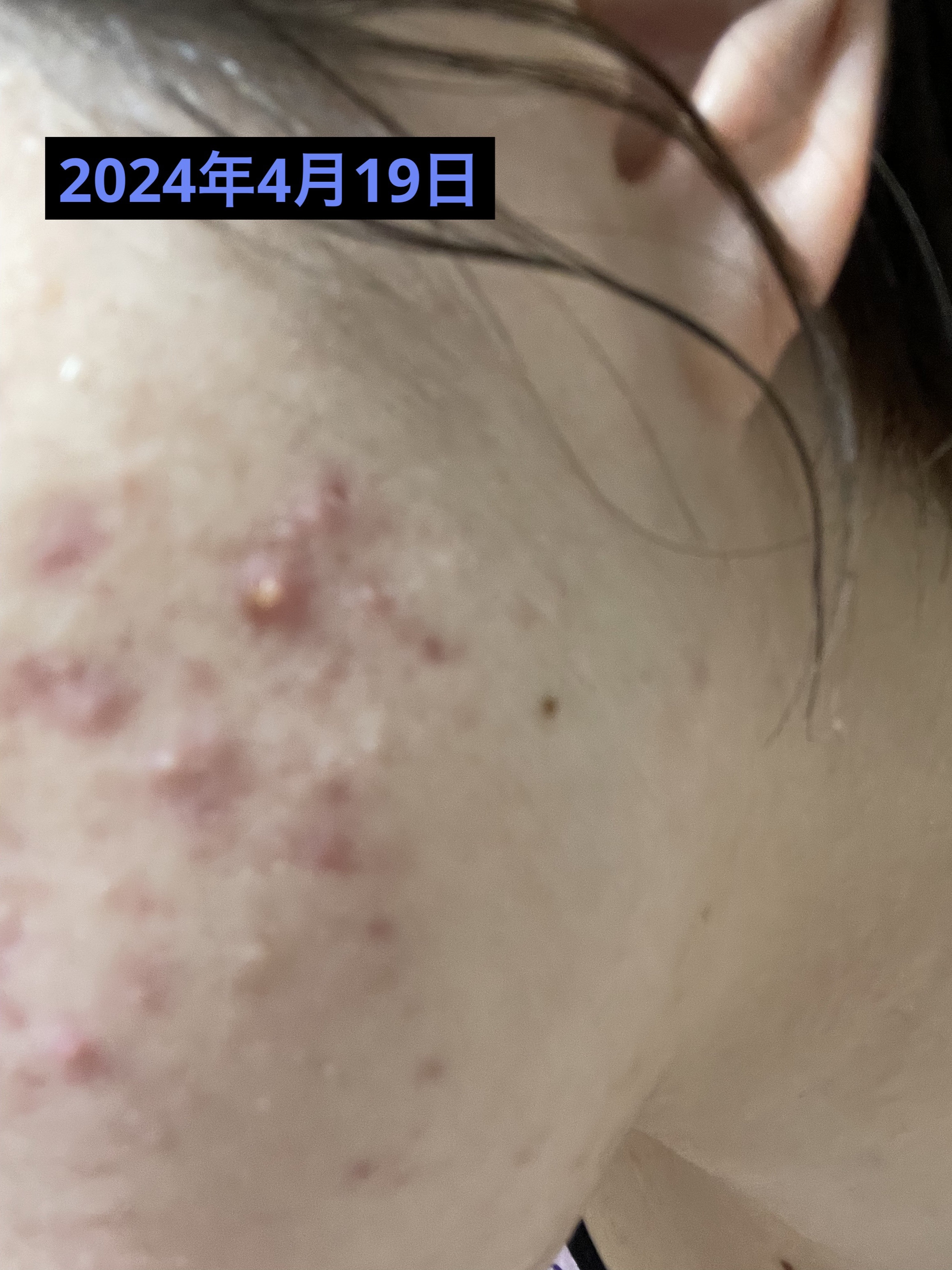 アポスティークリーム(医薬品)/アポスティー/その他を使ったクチコミ（3枚目）