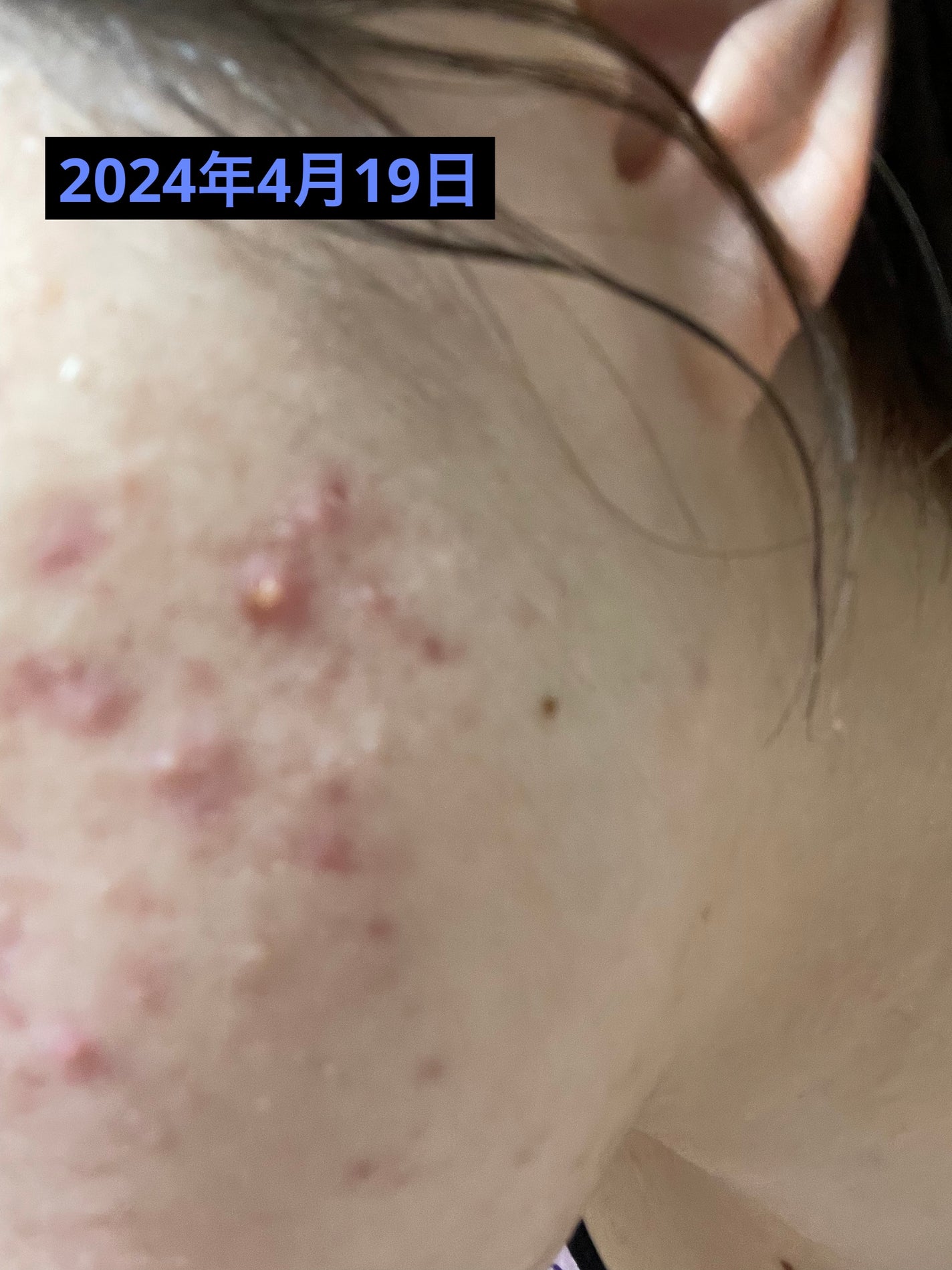 アポスティークリーム(医薬品)/アポスティー/その他を使ったクチコミ(3枚目)