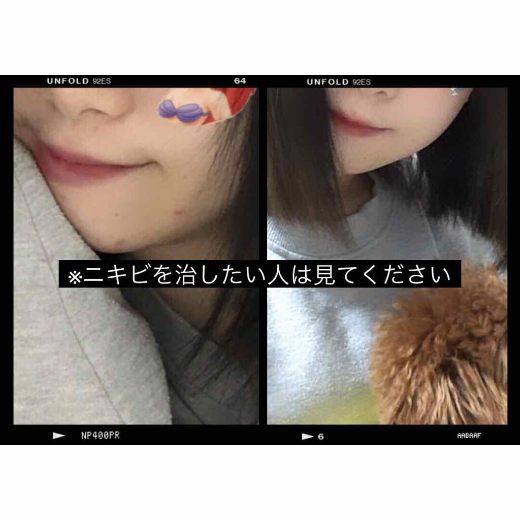 ペアアクネクリームW(医薬品)/ペア/その他を使ったクチコミ（1枚目）