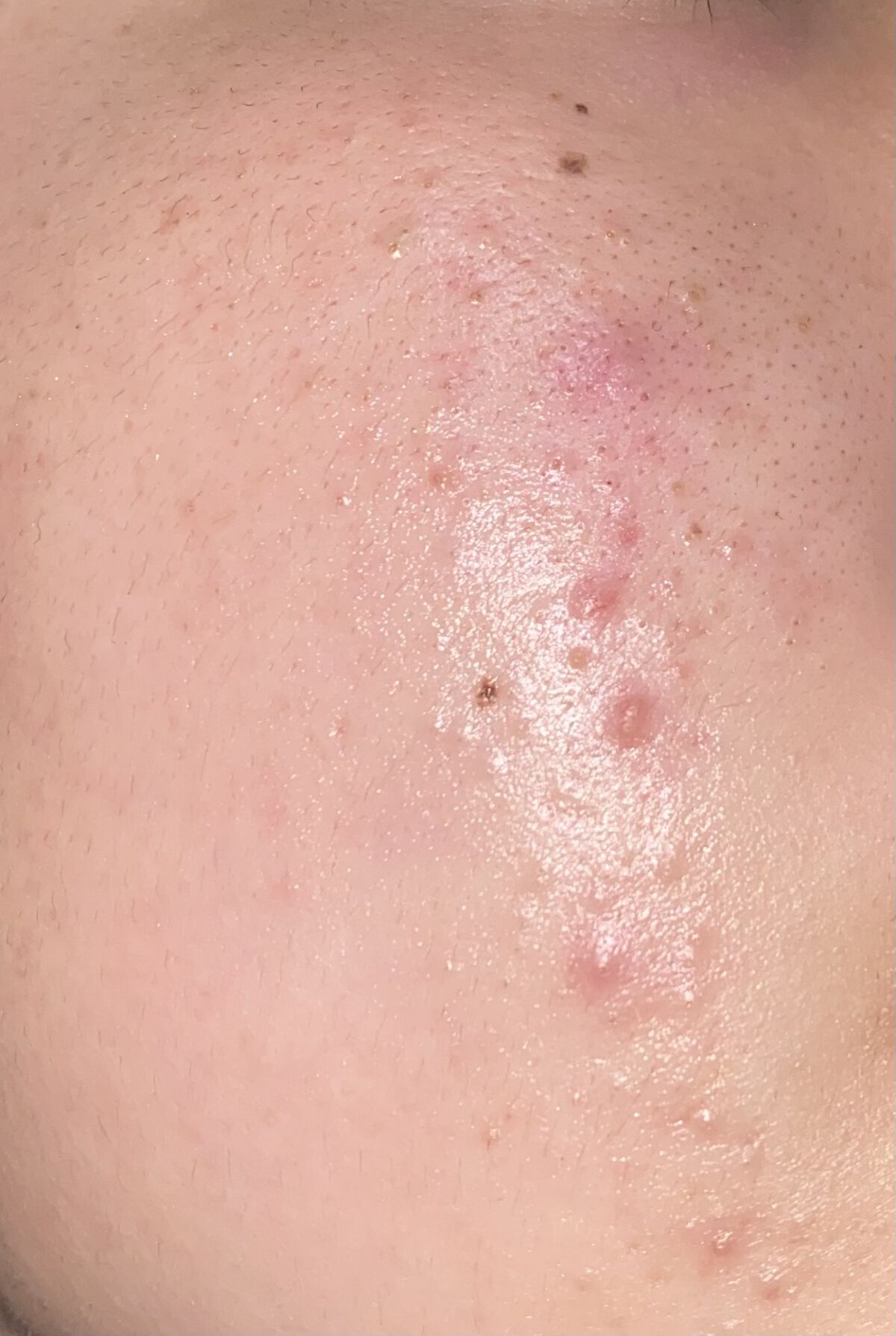 アクアチム軟膏1%/大塚製薬/その他スキンケアを使ったクチコミ（1枚目）