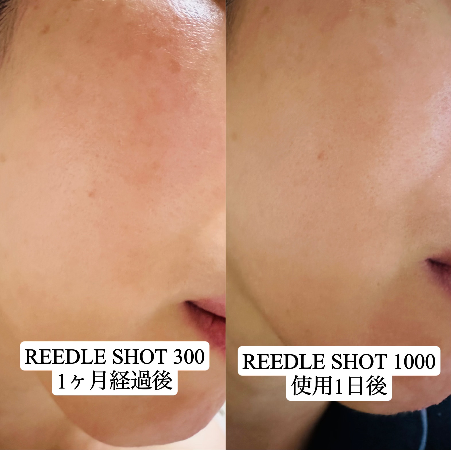 【新品】リードルショット 1000 VT リードルショット1000 VTコスメティックスVT コスメティックス 公式
