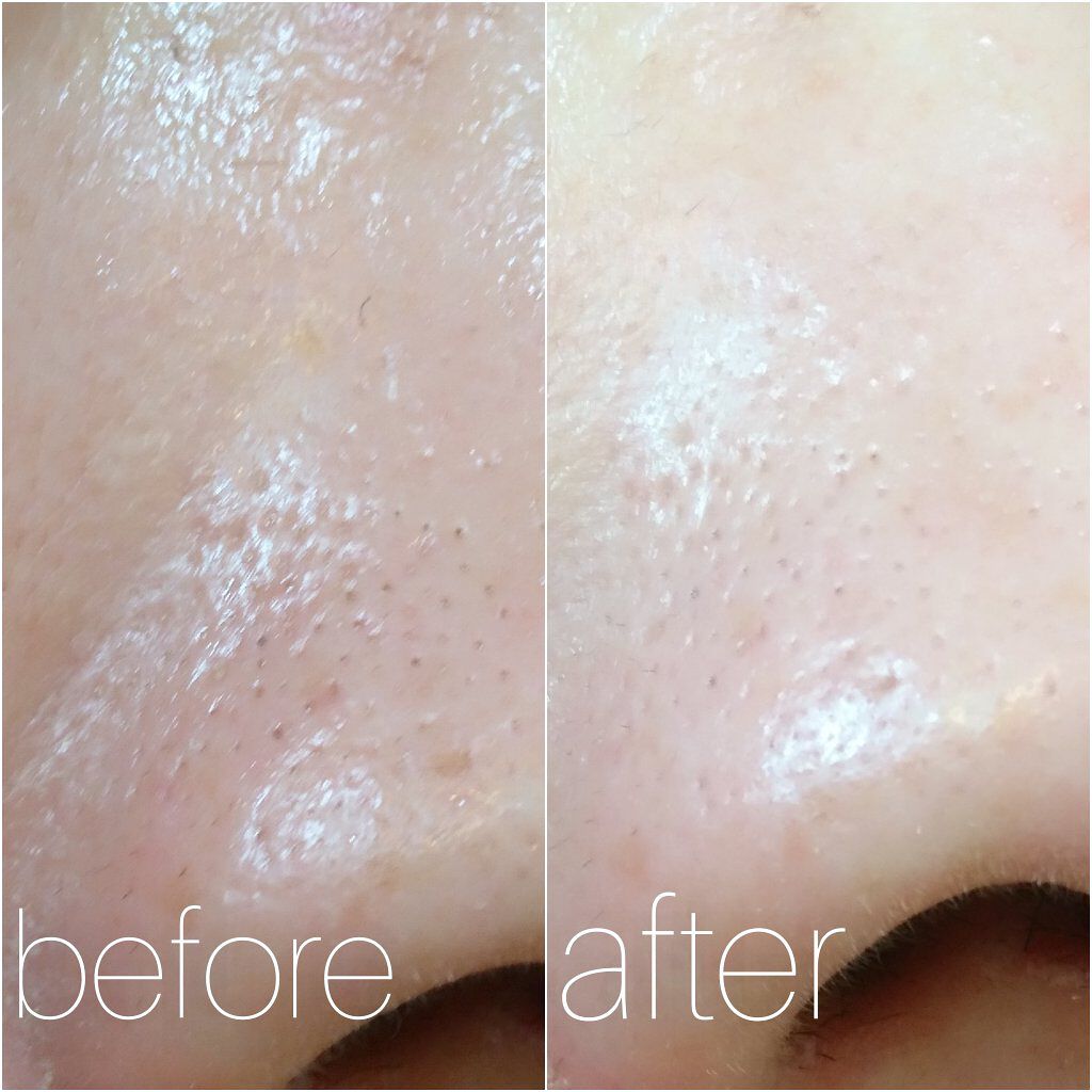 ポアゼロクリアジェル/BRTC/ピーリングを使ったクチコミ（3枚目）