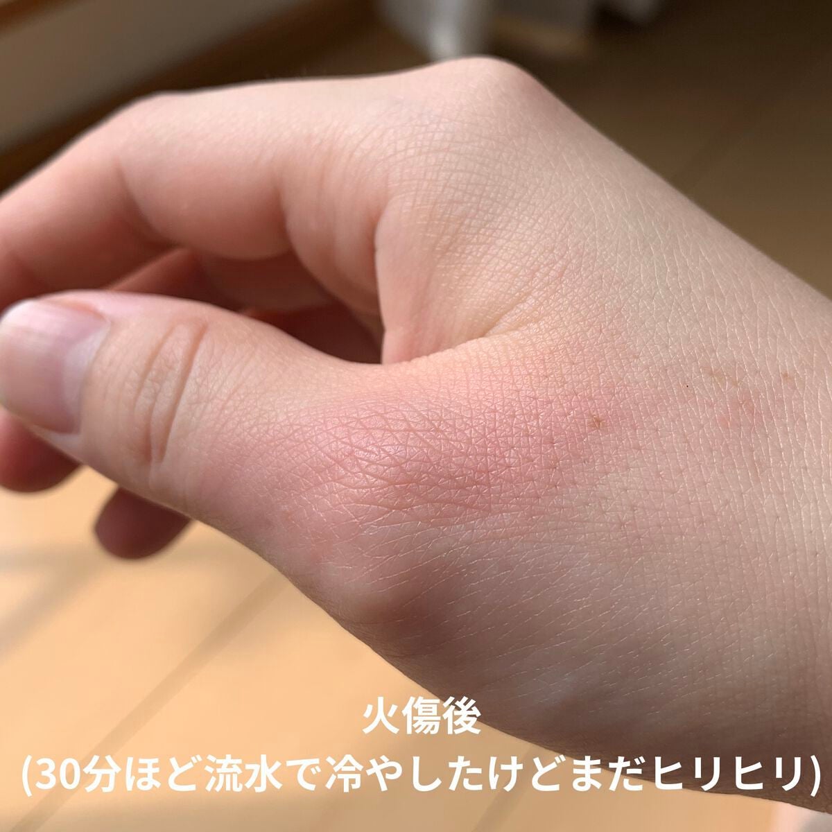 「間宮」アロエ軟膏 (医薬品)/アロエ製薬/その他を使ったクチコミ(6枚目)