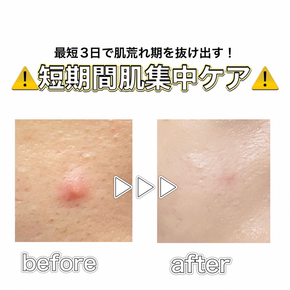 A アクネフォーム/NOV/洗顔フォームを使ったクチコミ（1枚目）