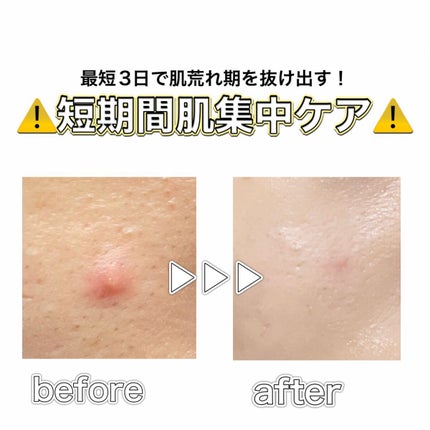 A アクネフォーム/NOV/洗顔フォームを使ったクチコミ(1枚目)