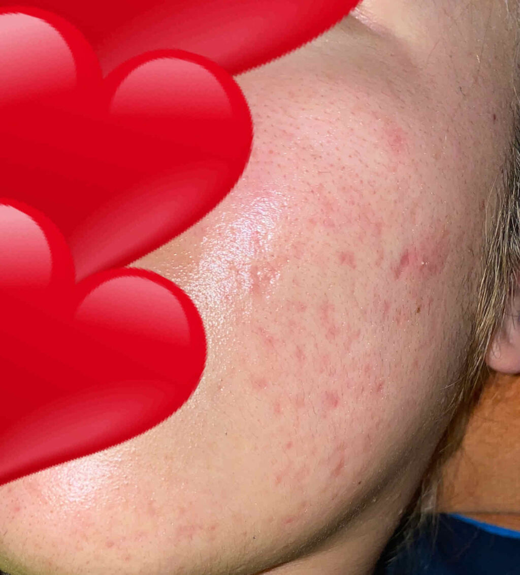 ペアアクネクリームW(医薬品)/ペア/その他を使ったクチコミ（3枚目）