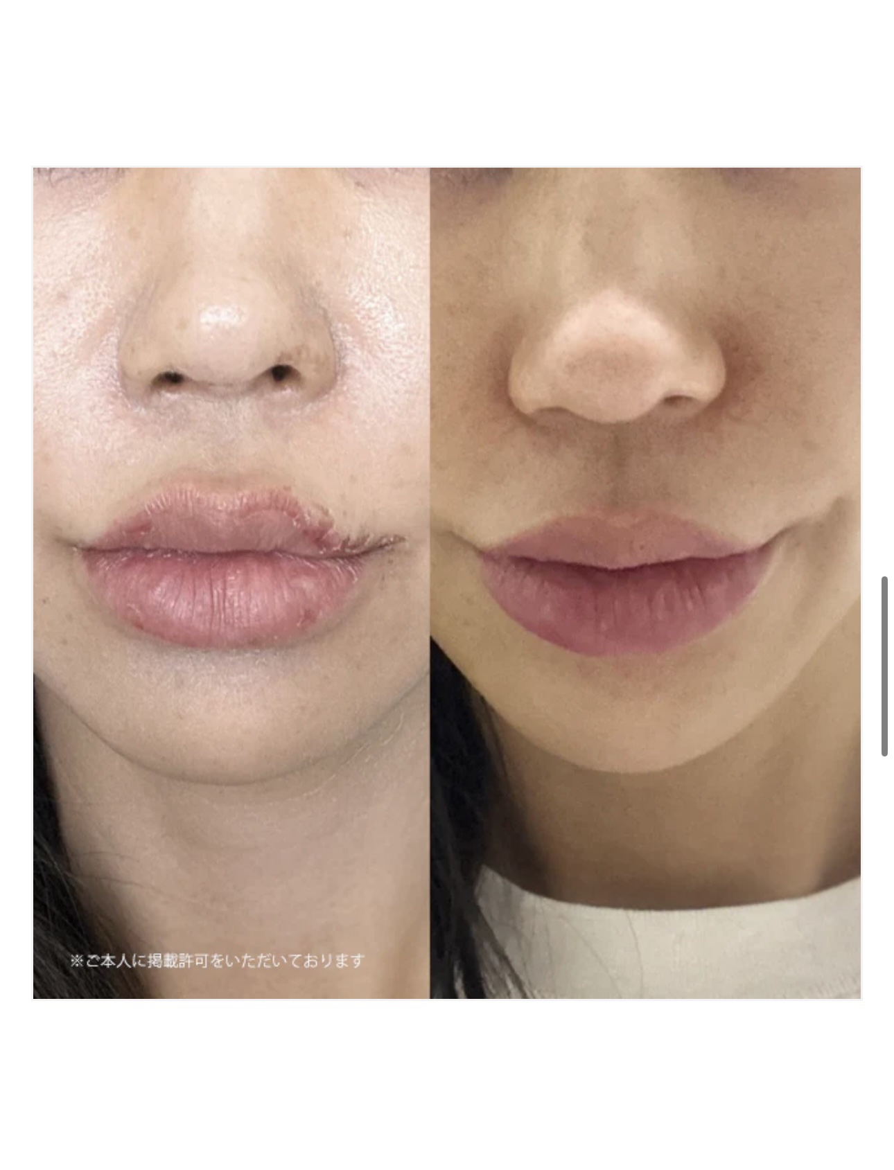 皮膚科や内科でも使われているSage Beauty Oil ビフォーアフター :

Sage ビューティーブレンドはオメガ6＆9とポリフェノールを含むファイトケミカルが豊富に含まれ、強力な抗酸化作用があります。一年中輝く健康的な肌のための、