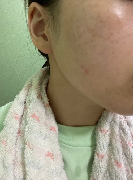 スキンピールバー ハイドロキノール/サンソリット/洗顔石鹸を使ったクチコミ(1枚目)