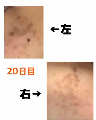 しょも on LIPS 「【20日目】17日目にはかさぶた取れてたのですが、噂に聞いてい..」（2枚目）