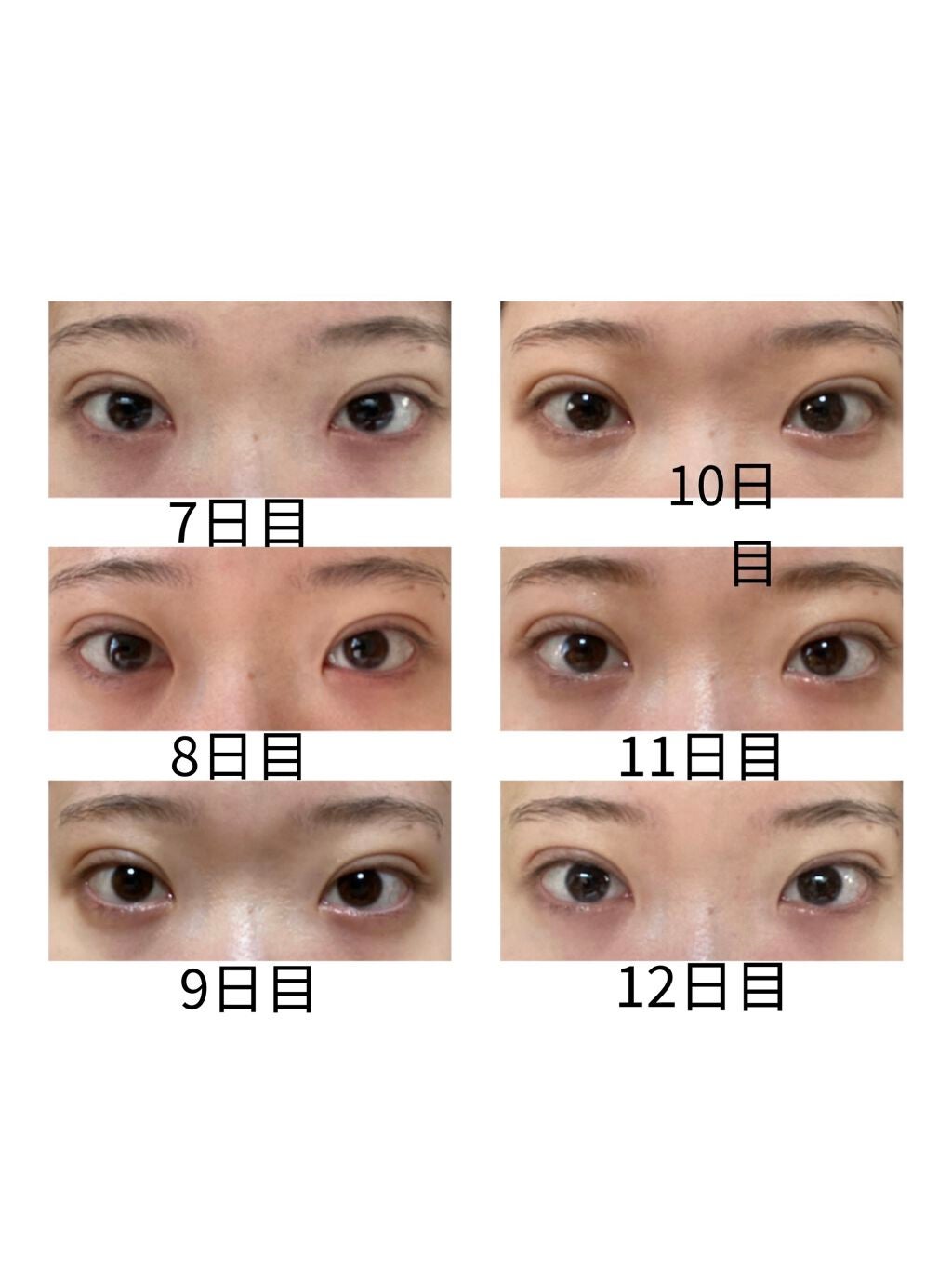 大福もち on LIPS 「念願だった二重整形をしてきました💖※1枚目は同じプリ機で撮影し..」(4枚目)