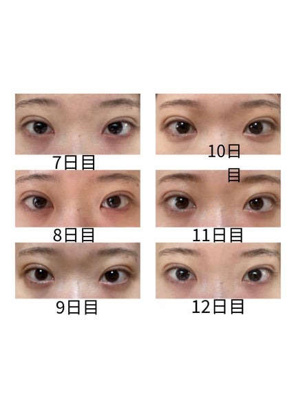 大福もち on LIPS 「念願だった二重整形をしてきました💖※1枚目は同じプリ機で撮影し..」(4枚目)