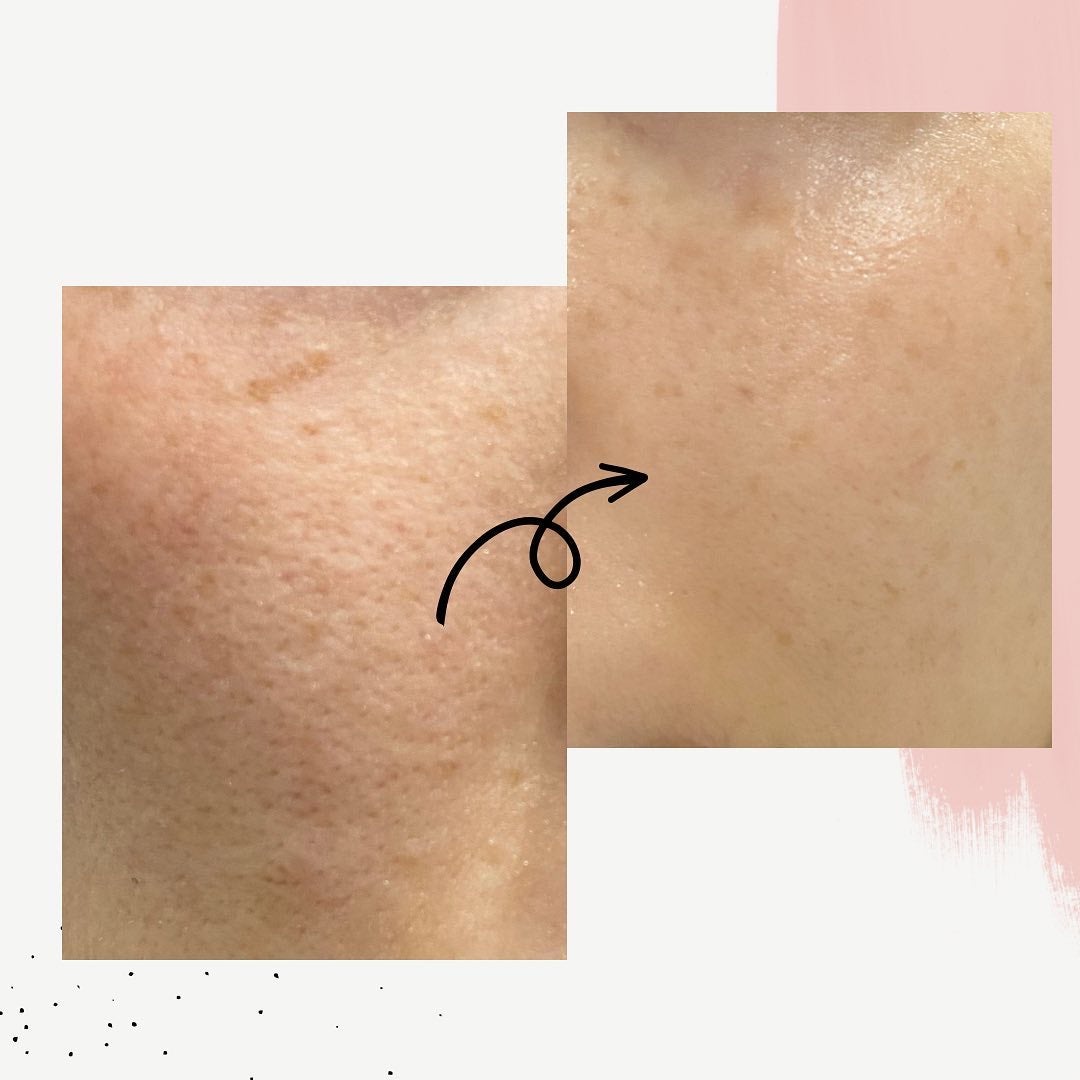 タカミスキンピール/タカミ/ブースター・導入液を使ったクチコミ(3枚目)