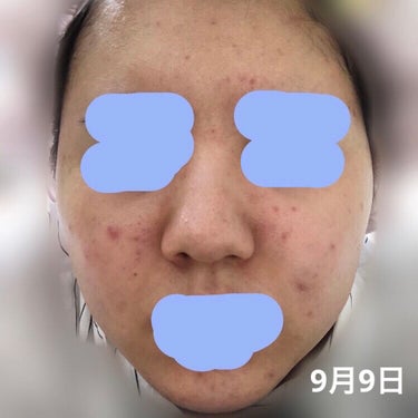 せんり on LIPS 「汚肌注意⚠️2、3枚目顔の写真あります、ほんとに汚いので苦手な..」（2枚目）