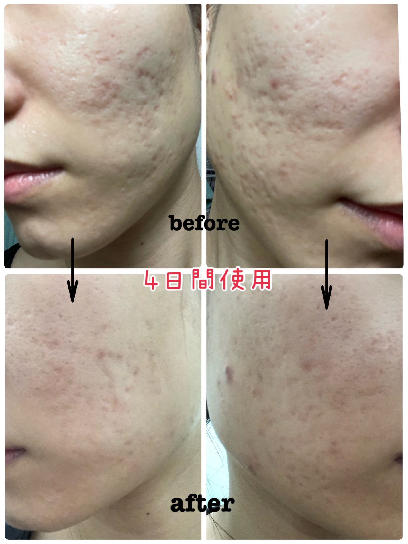 妃綏 on LIPS 「追加の投稿です🙋♀️✨ブースタープロを使用する前と使用して4..」(2枚目)