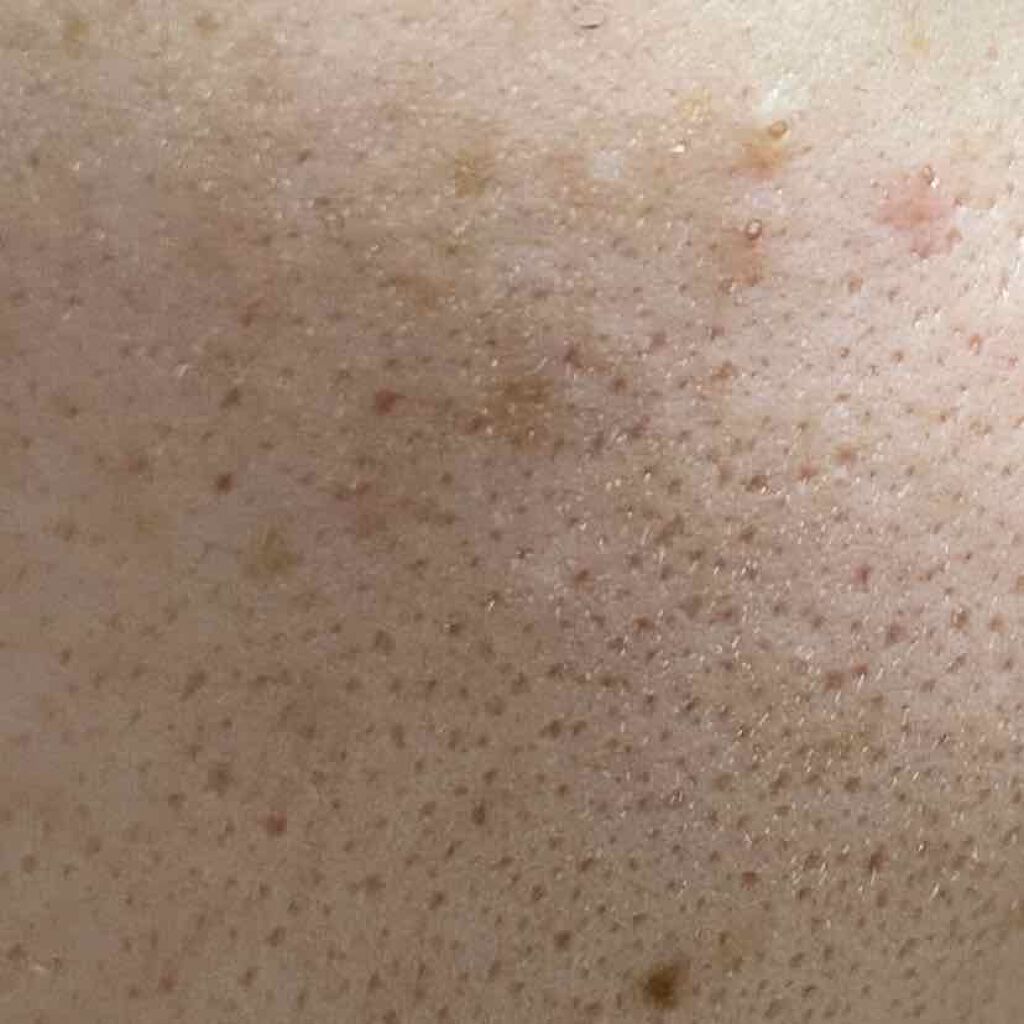 さ(肌荒れ女子) on LIPS 「初めて投稿させていただきます。2枚目閲覧注意です。載せている写..」(2枚目)