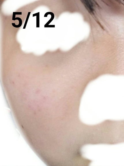 ロゼット洗顔パスタ アクネクリア/ロゼット/洗顔フォームを使ったクチコミ(3枚目)