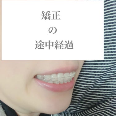 める☺︎︎ on LIPS 「矯正始めて半年経ちました𖦊経過レポです！2021.03.08現..」（1枚目）