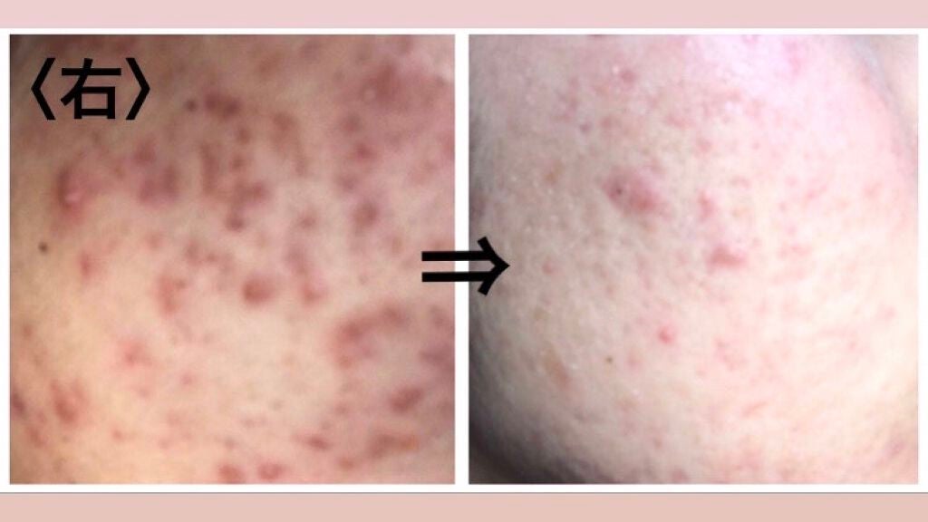 ð§ž on LIPS ãã1幎éã§å°ãã ãããããèãããæ¹æ³ããã£ãšãããããããè·¡..ãïŒ1æç®ïŒ