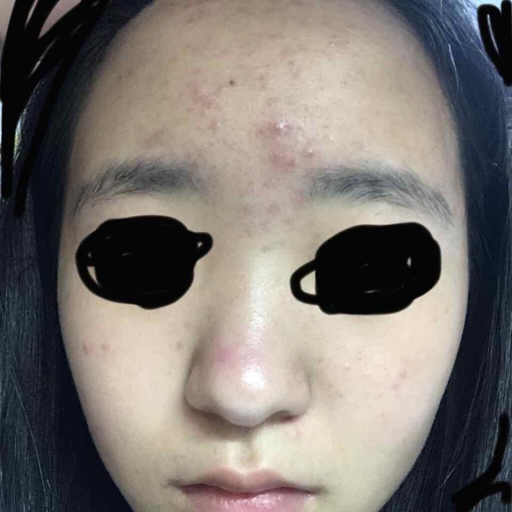 コスメ好きな妹 on LIPS 「助けて下さい!!!突然ですが私ニキビがやばいんです!休業前好き..」(1枚目)