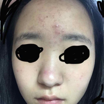 コスメ好きな妹 on LIPS 「助けて下さい!!!突然ですが私ニキビがやばいんです!休業前好き..」(1枚目)