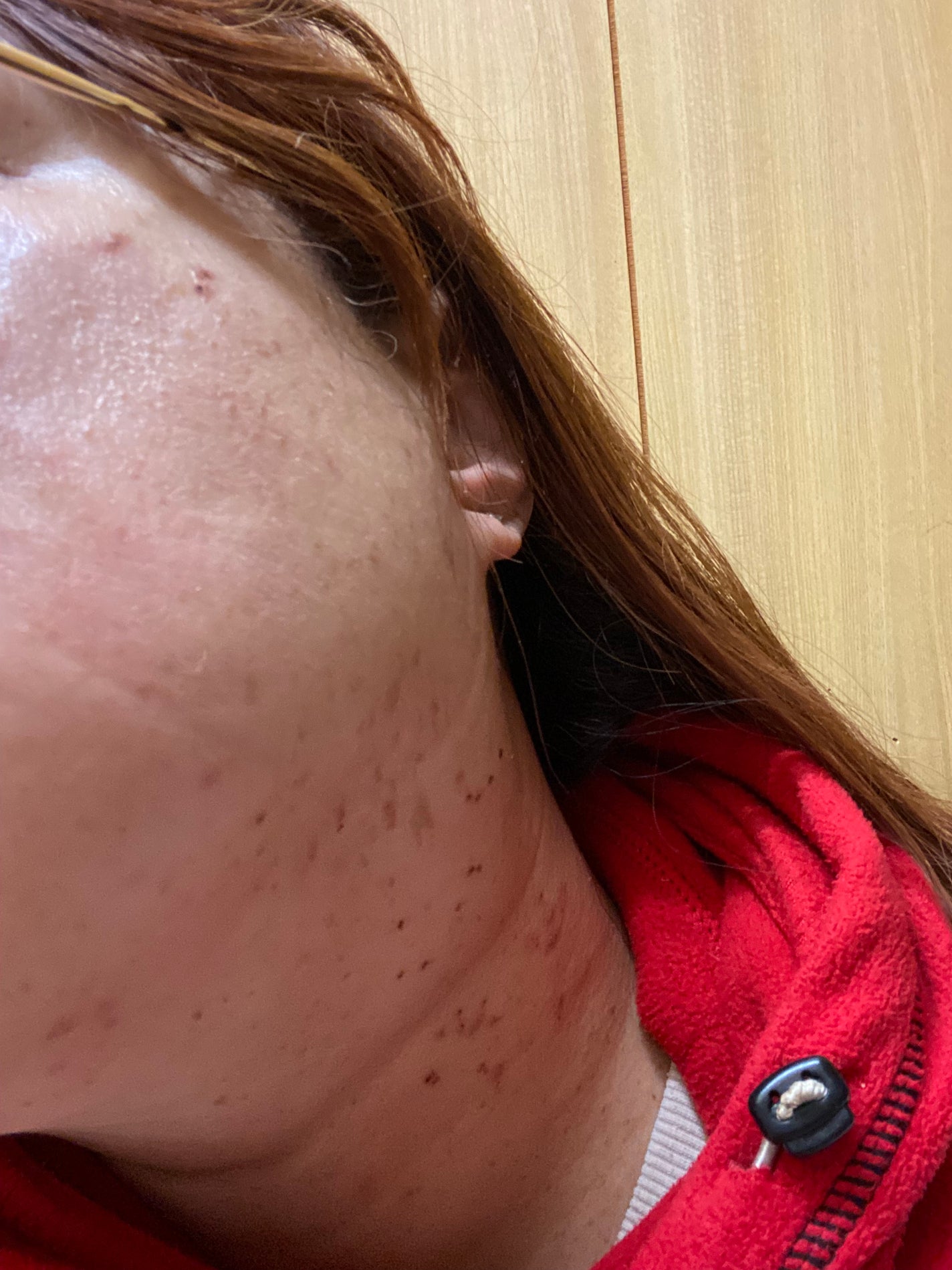 リサ・ラーソン♡クッションファンデマニア on LIPS 「#皮膚科#レーザー治療#シミ取り#チュートリアル..」(1枚目)