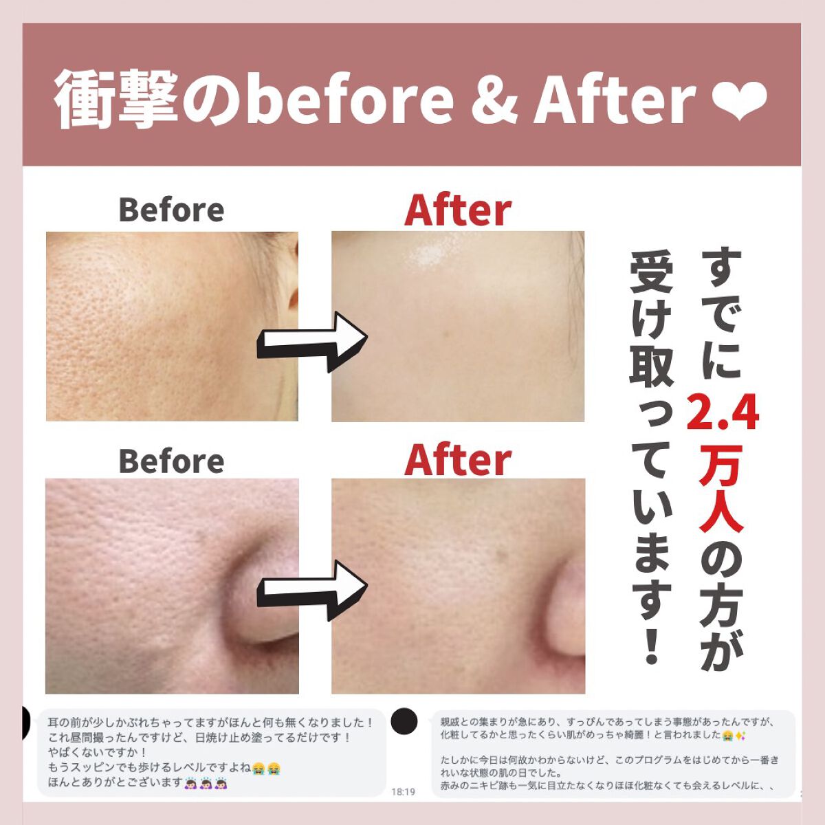 あなたの肌に合ったスキンケア💐コーくん先生 on LIPS 「【効きすぎ注意】毛穴の開き最短で消す方法.
.
あなたの毛穴悩..」(8枚目)