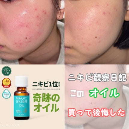 マジックティーツリーオイル/ブラン/フェイスオイルを使ったクチコミ(1枚目)