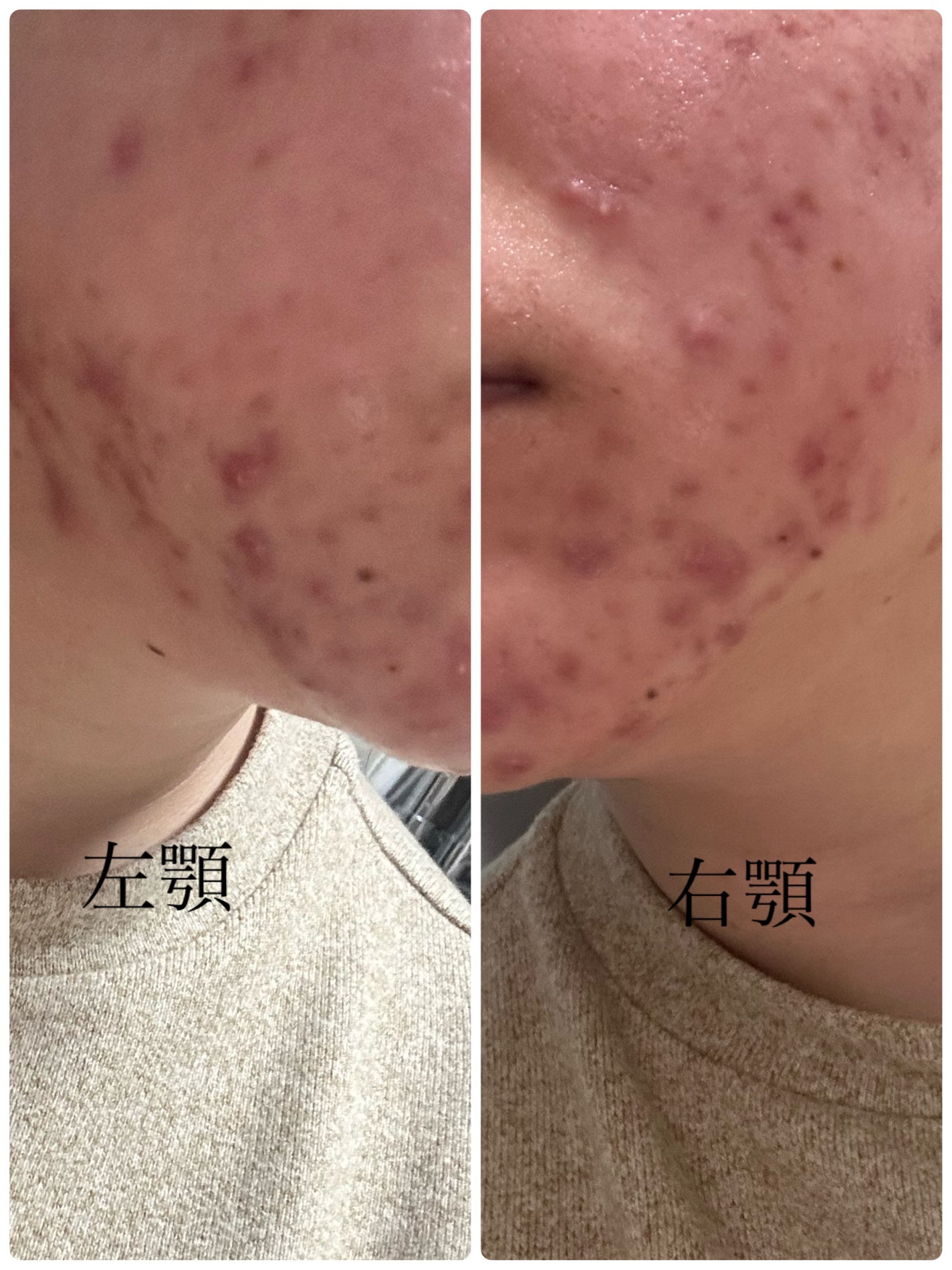 さめちゃん on LIPS 「ニキビ治療初めて1日目日記程度に書き込んで行きます📖☡✍凸凹の..」(1枚目)