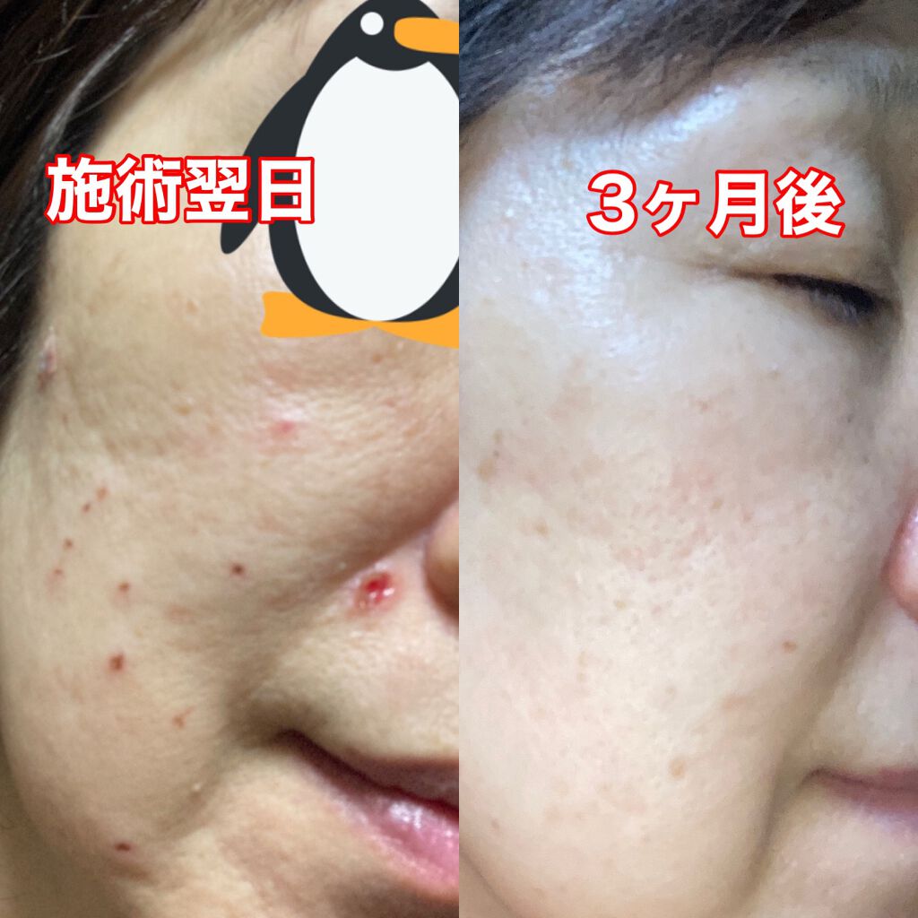 ネイチャーコンク 薬用クリアローション/ネイチャーコンク/拭き取り化粧水を使ったクチコミ（3枚目）