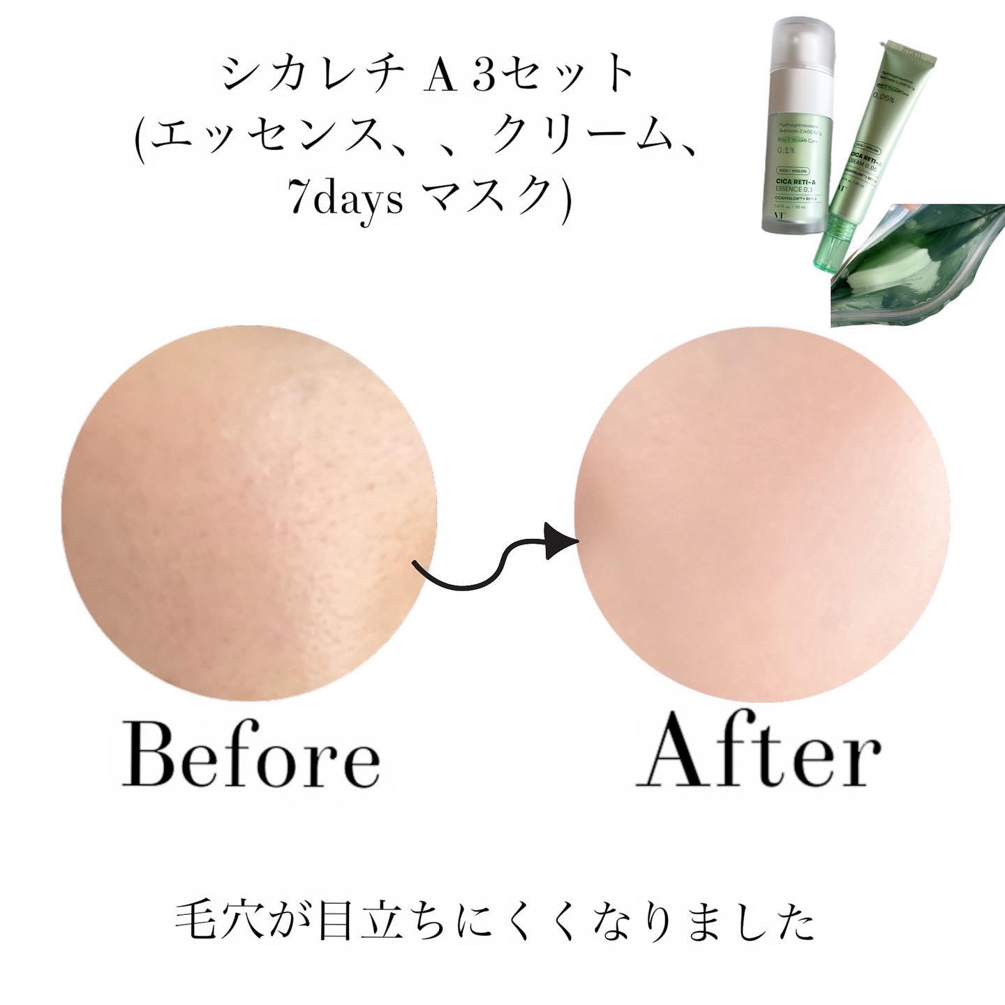 シカレチA エッセンス0.1/VT/美容液を使ったクチコミ（2枚目）