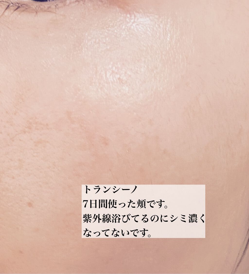 薬用ホワイトニングエッセンスEXII/トランシーノ/美容液を使ったクチコミ（2枚目）