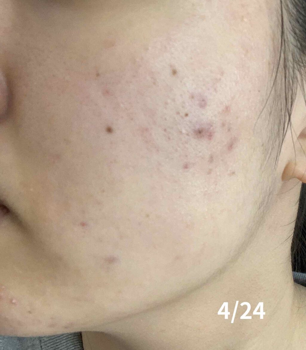 薬用 しみ 集中対策 美容液/メラノCC/美容液を使ったクチコミ(2枚目)