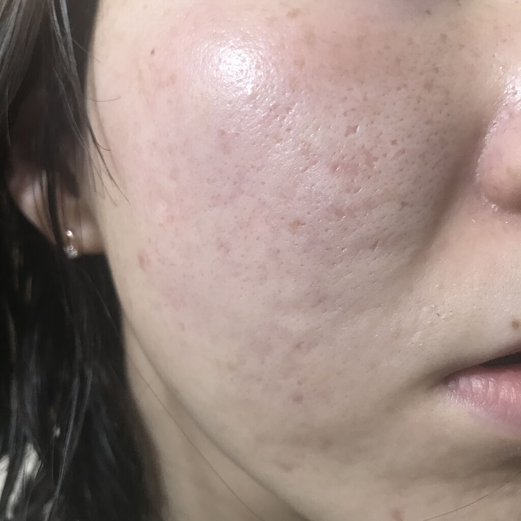 ティーツリーケア ソリューション エッセンシャルマスクEX/MEDIHEAL/シートマスク・パックを使ったクチコミ（1枚目）