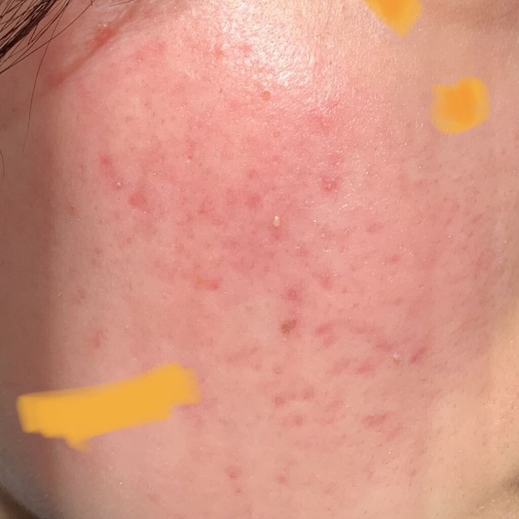 ハトムギ化粧水(ナチュリエ スキンコンディショナー R )/ナチュリエ/化粧水を使ったクチコミ（1枚目）