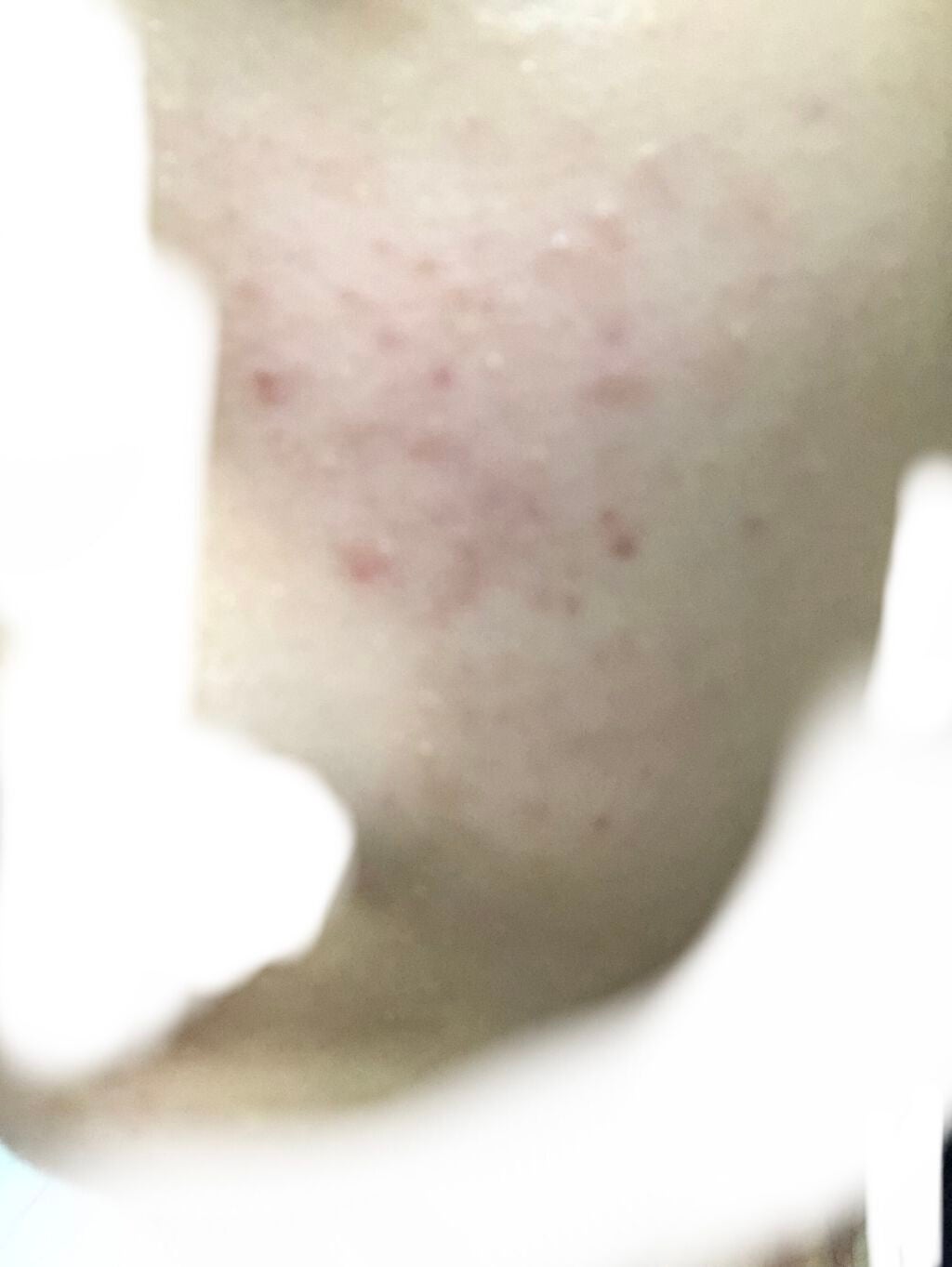 なな on LIPS 「みなさんこんにちは!肌断食をしたところちょくちょく治るところは..」(1枚目)